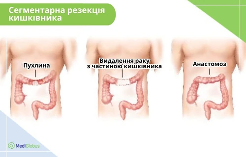 Резекція кишечника Схематичні зображення етапів видалення пухлини кишечника