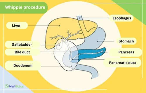 Whipple surgery for colon cancer Whipple surgery for colon cancer