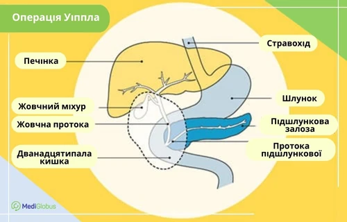 Операція Уіппла при раку кишечника Медична схема органів травної системи з позначенням ділянок, що задіяні в операції Віппла