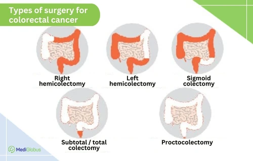 Surgery for colorectal cancer Surgery for colorectal cancer