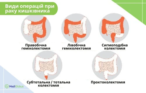 Види операцій при раку кишечника Інфографіка: види операцій при раку кишечника