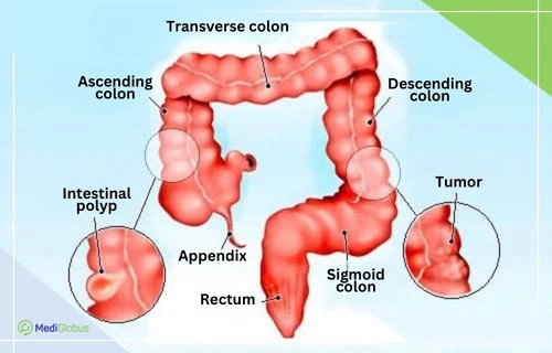 colon cancer