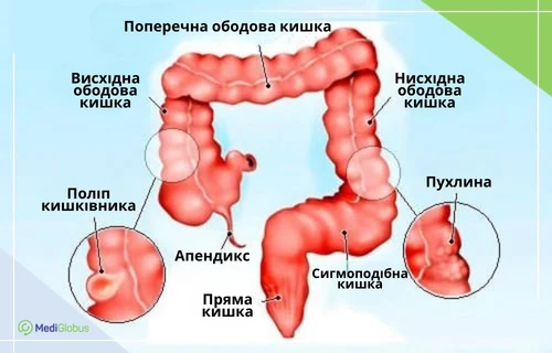 Пухлина в кишечнику, поліп кишечника Медична схема товстого кишечника людини з позначеннями відділів та патологіями