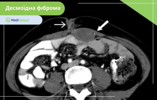 Комп'ютерна томографія черевної порожнини; стрілками позначено овальне утворення в передній черевній стінці, що відповідає десмоїдній фібромі