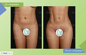 самая эффективная липосакция