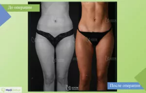 Липосакция в клинике Estetik International Фотографии до и после липосакции
