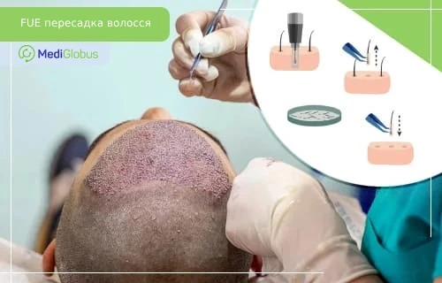 FUE-пересадка волосся — щадний метод відновлення волосся з індивідуальним вилученням фолікулів Лікар проводить FUE-пересадку волосся; на голові пацієнта видно імплантовані графти