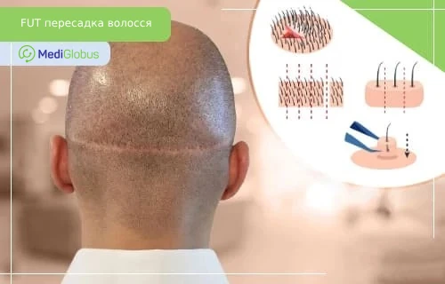 Потилиця чоловіка зі шрамом після FUT-пересадки волосся та схема етапів трансплантації