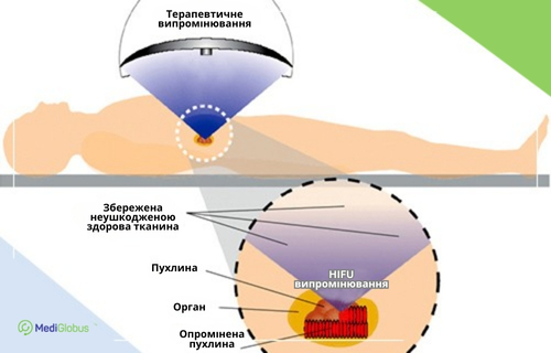 HIFU-терапія в лікуванні раку грудей Медична схема проведення HIFU-терапії: пацієнт лежить на столі, над ділянкою пухлини розташований апарат, що направляє терапевтичне випромінювання; на збільшеному фрагменті показано, як HIFU-промені впливають на пухлину, зберігаючи здорові тканини.