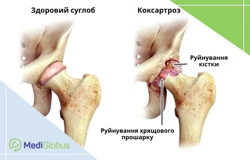 На ілюстрації порівняно здоровий тазостегновий суглоб і суглоб, уражений коксартрозом, із зазначенням руйнування хрящового прошарку та кісткової тканини
