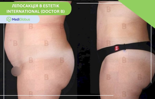Фотографії до та після ліпосакції у клініці Естетик Інтернешнл