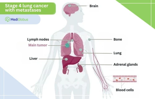 Metastases in stage 4 lung cancer Metastases in stage 4 lung cancer