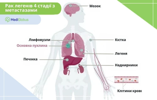 Метастази при раку легень 4 стадії Схематичне зображення людського тіла з позначенням органів, уражених метастазами при раку легенів 4-ї стадії; показано поширення пухлинних клітин через кров