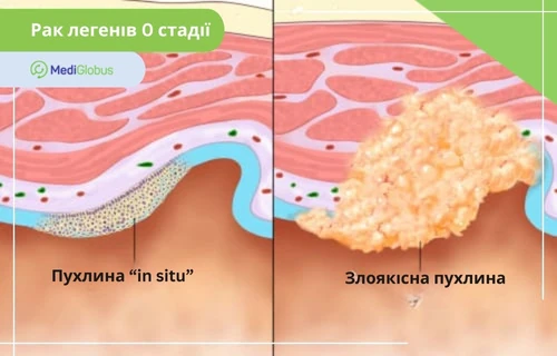 Рак легенів 0 стадії порівняння двох стадій раку легенів: ліворуч — пухлина in situ, обмежена поверхневим шаром тканини; праворуч — злоякісна пухлина, що проростає вглиб тканин