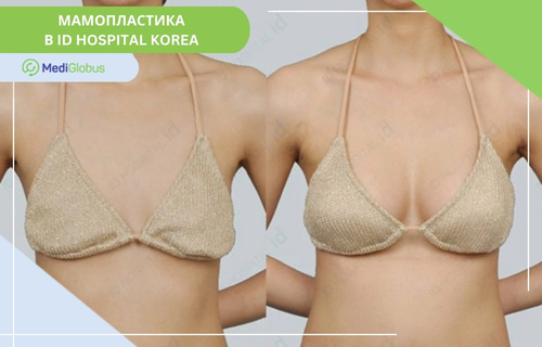Мамопластика в Південній Кореї, клініка ID Hospital Фотографії до та після мамопластики у клініці АйДі Хоспітал
