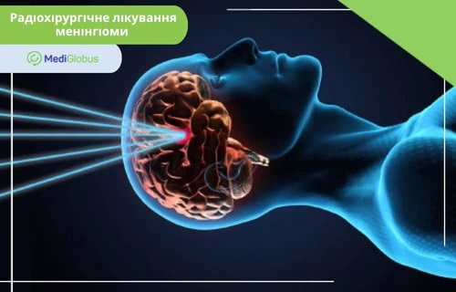 Радіохірургія при менінгіомі — неінвазивний метод лікування пухлин мозку за кордоном Стилізація радіохірургічного лікування менінгіоми головного мозку