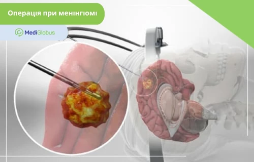 Методи лікування менінгіоми мозку Медична 3D-ілюстрація видалення менінгіоми головного мозку