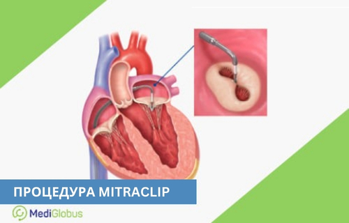 Mitrclip при недостатності мітрального клапана Анатомічна ілюстрація серця з виділеною ділянкою мітрального клапана; показано процес встановлення пристрою MitraClip, що з’єднує стулки клапана; поруч — збільшене зображення інструменту, що фіксує клапан