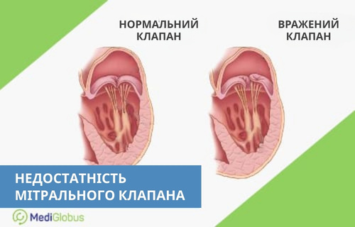 Що таке недостатність клапана Порівняння здорового мітрального клапану і враженого хворобою