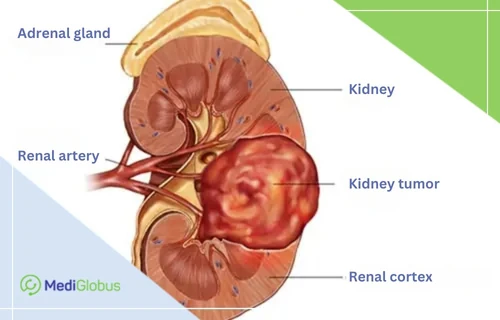 nefroblastoma-y-rebenka-en Surgery for nephroblastoma