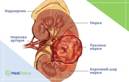 Схематичне зображення нирки з пухлиною
