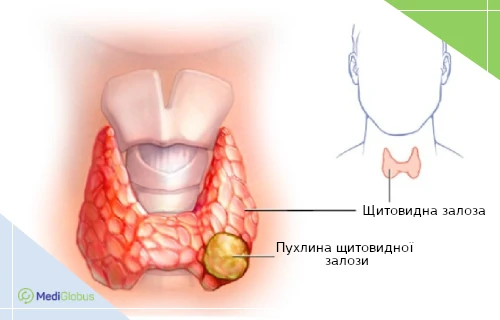 пухлина щитовидної залози схематичне зображення пухлини щитоподібної залози