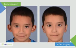 Otoplasty in Israel otoplasty for children photos before and after surgery