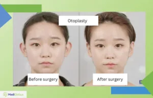 Otoplasty photos before and after surgery Korea ID hospital Otoplasty photos before and after surgery Korea ID hospital