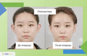 фото до та після отопластики в Кореї фото до та після отопластики