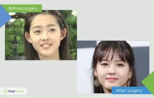 Otoplasty photo after surgery Korea Otoplasty photo after surgery Korea