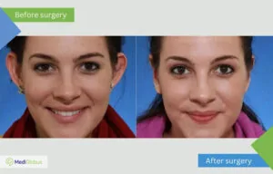 Otoplasty in Turkey Otoplasty photos before and after Turkey