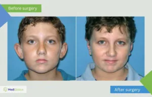 Otoplasty in Turkey otoplasty in children before and after photos