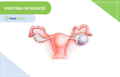 Фіброма яєчників Медична ілюстрація жіночої репродуктивної системи: матка, маткові труби та яєчники; на правому яєчнику зображено округле утворення сіро-фіолетового кольору, що позначає фіброму.