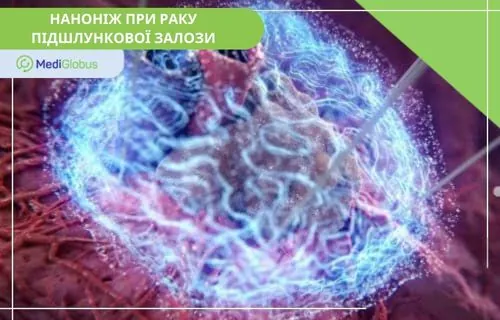Наноніж при раку підшлункової залози ілюстрація впливу на пухлинні клітини за допомогою спрямованого випромінювання або нанотехнологій