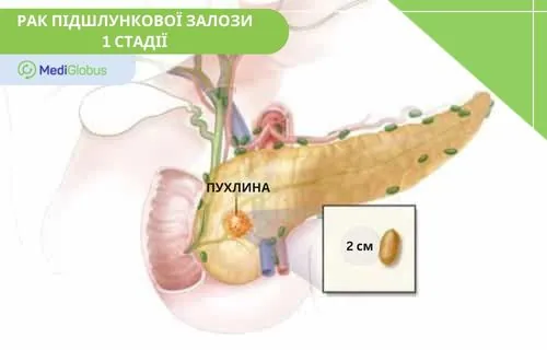 1 стадія раку підшлункової залози схематичне зображення підшлункової залози та пухлини 1-ї стадії