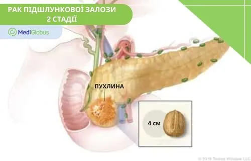2 стадія раку підшлункової залози схематичне зображення підшлункової залози та пухлини 2-ї стадії