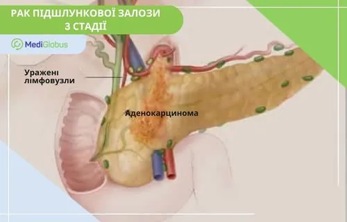 3 стадія раку підшлункової залози схематичне зображення підшлункової залози та пухлини 3-ї стадії