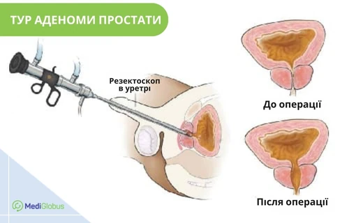 ТУР аденоми простати Медична схема операції ТУР аденоми простати: ліворуч зображено резектоскоп, введений через уретру, праворуч — порівняння стану простати до та після операції