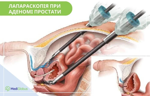 Лапараскопія при аденомі простати Медична ілюстрація лапароскопічної операції при аденомі простати: показано інструменти, введені через черевну стінку, та анатомічні структури малого таза