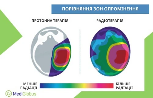 Порівняння ураження мозку радіацією при протонній терапії та радіотерапії Інфографіка: Порівняння ураження мозку радіацією при протонній терапії та радіотерапії