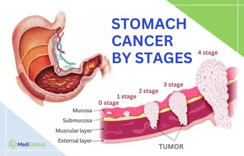 rak-zheludka-stadii-en stages of stomach cancer