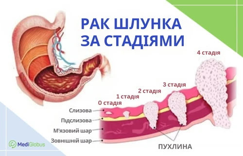 Стадії раку шлунка Схематичне зображення шлунка людини з пухлинами на різних стадіях