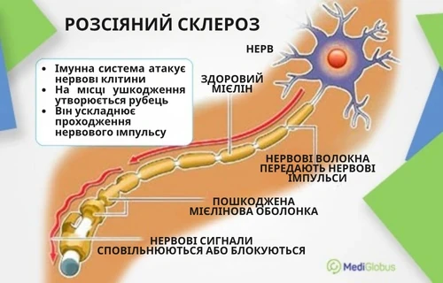 Схематичне зображення пошкодження мієліну в нейронах при розсіяному склерозі та порушення передачі нервових імпульсів; у лівому верхньому куті напис «Розсіяний склероз»