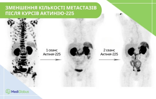 Результати лікування раку простати Актинієм-225 Три ПЕТ-знімки тіла пацієнта до та після лікування Актинієм-225: на першому видно численні вогнища метастазів, на другому та третьому їхня кількість помітно зменшується після 1 та 2 сеансів терапії