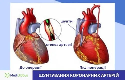 Скільки коштує і як проводиться шунтування коронарних артерій за кордоном Як виглядає серце до операції ортокоронарного шунтування та після операції