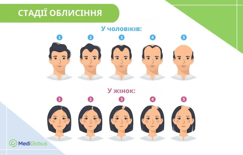 Інфографіка: Стадії облисіння при андрогенній алопеції у чоловіків і жінок