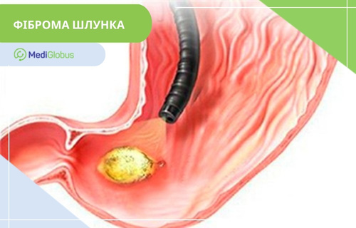 Фіброма шлунка Медична ілюстрація шлунка людини: показано внутрішню поверхню органу з вираженими складками слизової оболонки; через стравохід введено ендоскоп; поруч на стінці шлунка видно округле жовте утворення, що позначає фіброму.