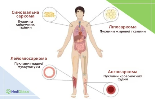 інфографіка із зображенням людського тіла та зазначенням чотирьох типів сарком м’яких тканин: синовіальна саркома, ліпосаркома, лейоміосаркома та ангіосаркома; поруч наведено схеми тканин, у яких виникають пухлини