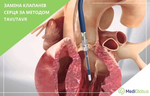 3D-візуалізація проведення процедури TAVI/TAVR; видно катетер, введений через судину в ділянку аортального клапана