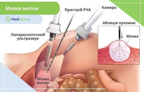 Радіочастотна абляція - безпечний метод лікування міоми матки Схематичне зображення проведення процедури радіочастотної абляції
